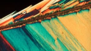 Pigment-Dispersion Syndrome — foto 4